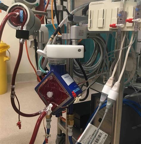 ecmo pump centrifugal|ecmo protocol.